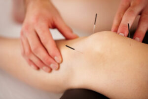 dry needling