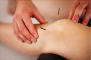 dry needling